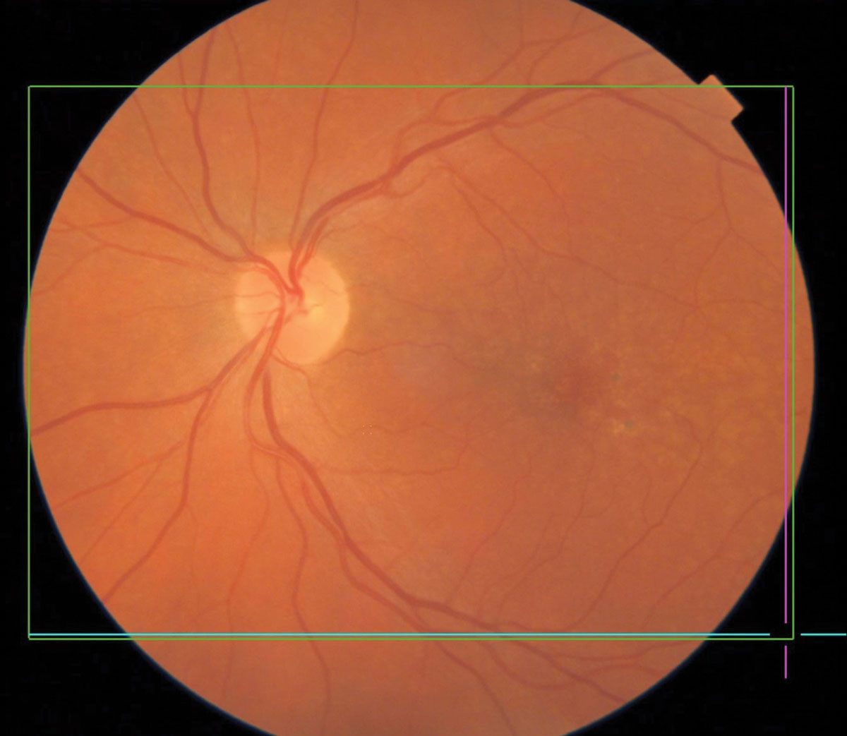 Pigmentary changes in dry AMD.