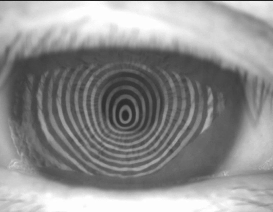 Irregular placido rings in corneal topography.