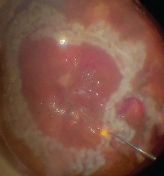 Some patients may experience ganglion cell loss post-vitrectomy.