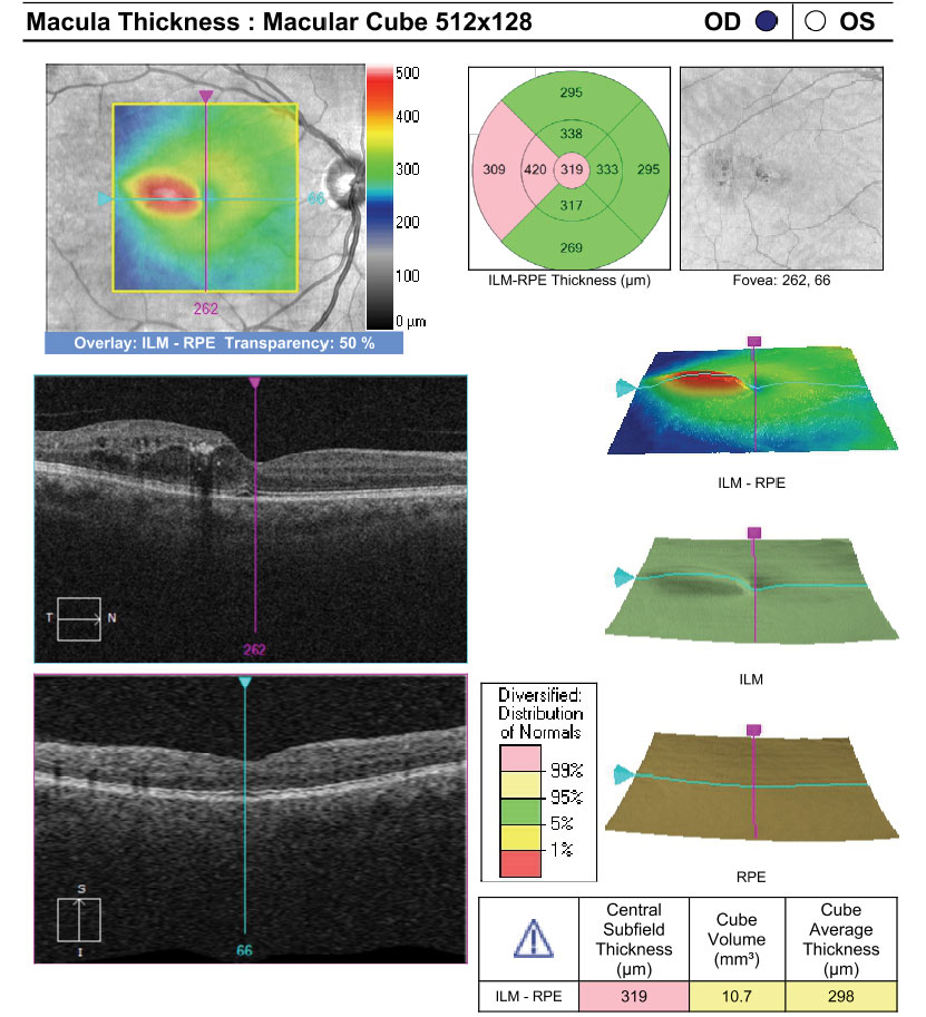 An increase in retinal extracellular fluid could signal an increased possibility of vision loss in patients with CI-DME.