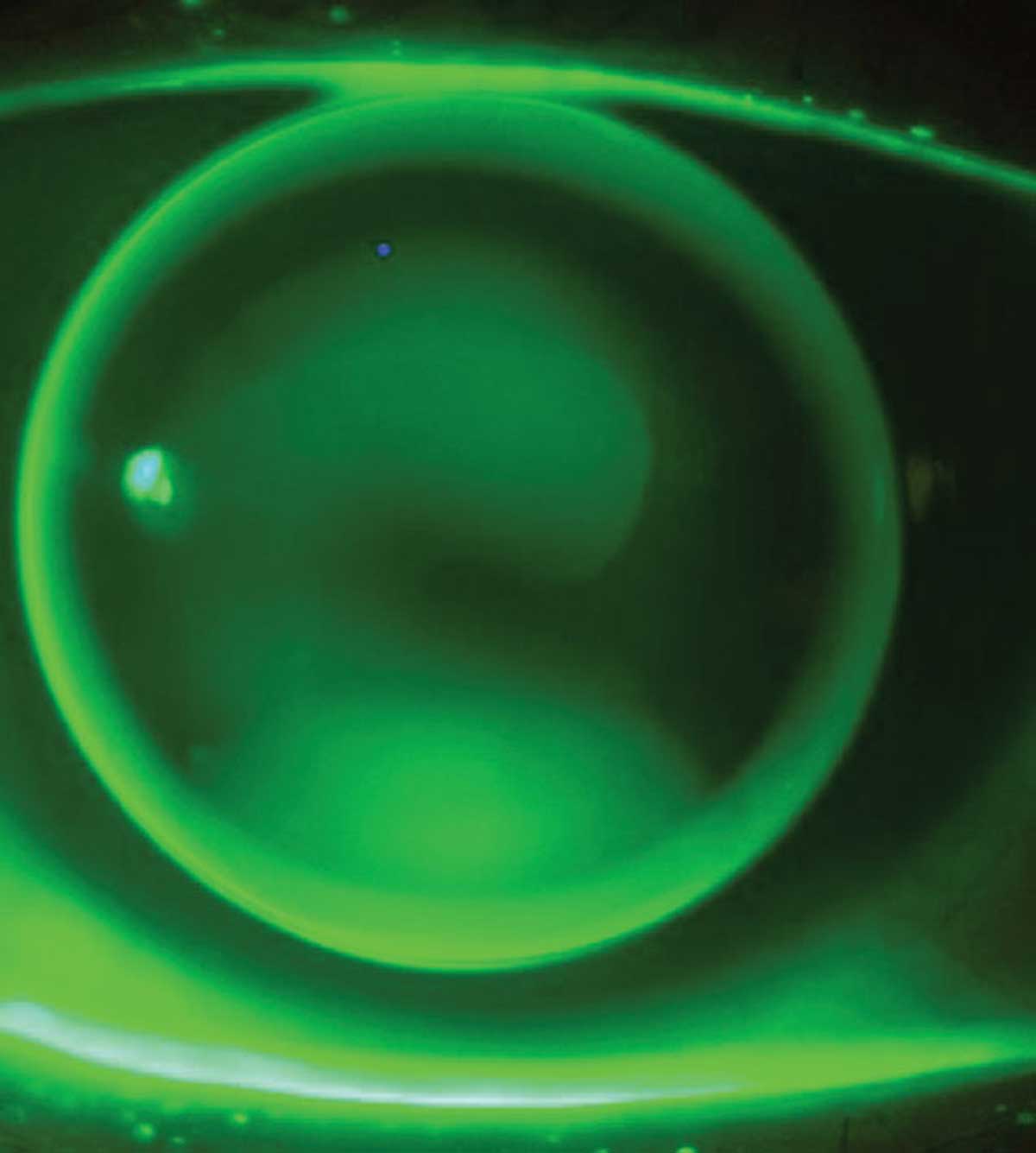 Corneal GP lenses remain the top choice in keratoconus management.