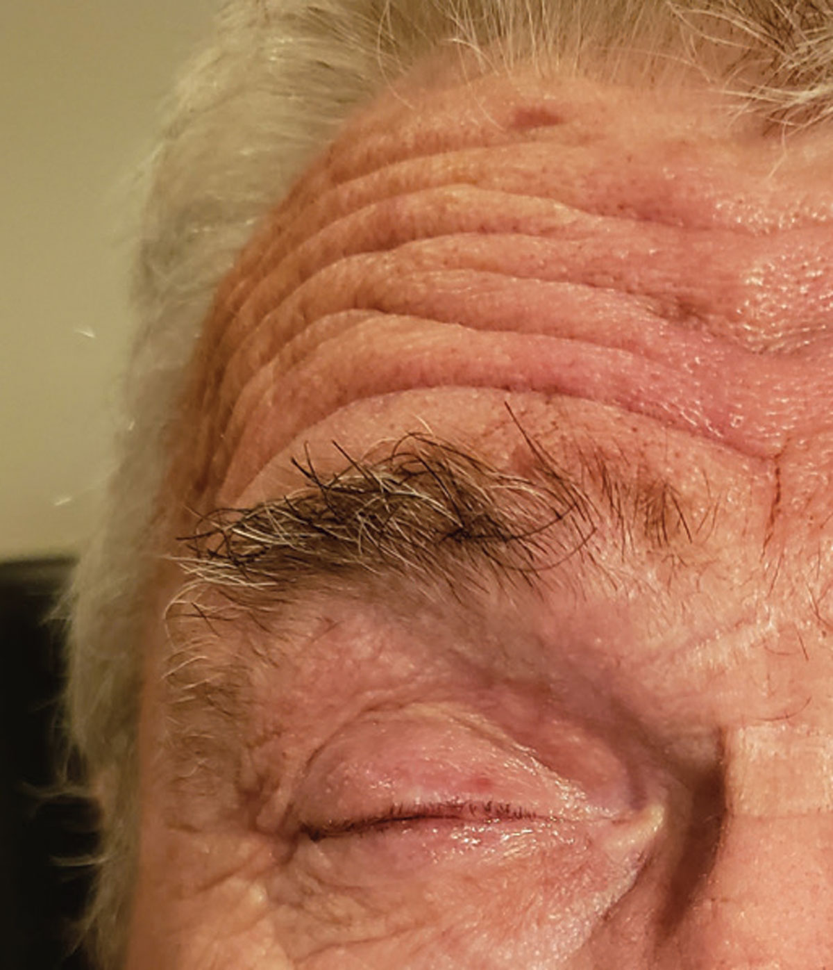Even mild zoster lesions, as seen on the forehead, can cause severe PHN.
