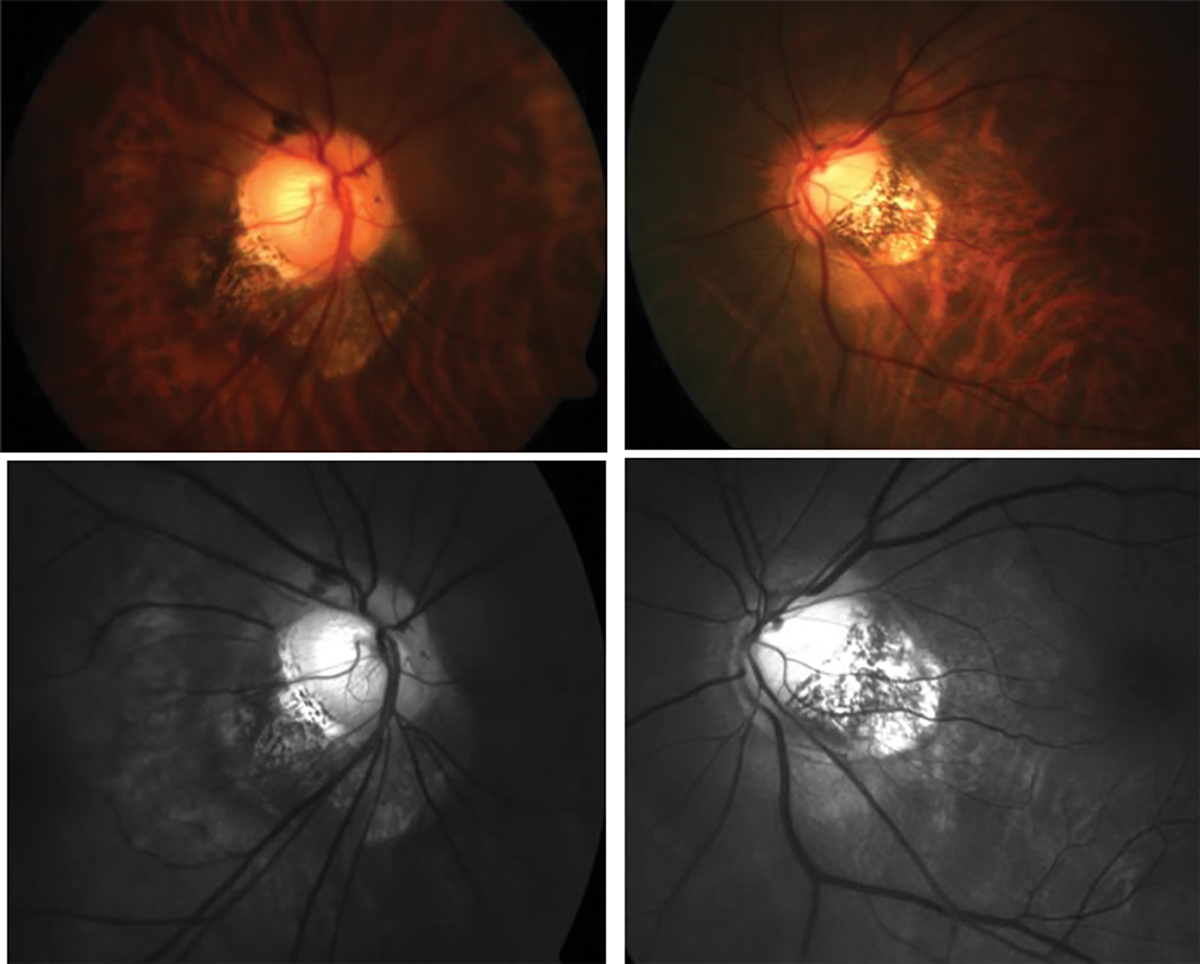 Fig. 2. Traditional fundus photography shows anomalous optic nerve insertion, tilting and torsion and posterior staphyloma in a highly myopic patient (top). Below is the same image of the optic nerves using red-free fundus photography to visualize the extent of thinning more easily (bottom).