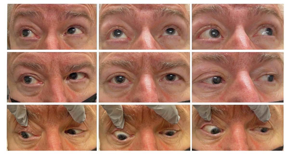 Fig. 1. Extraocular motilities in all gazes. Note periorbital fullness of the right side in primary gaze. There were adduction, abduction and supraduction limitations OD. Left eye motilities were full.