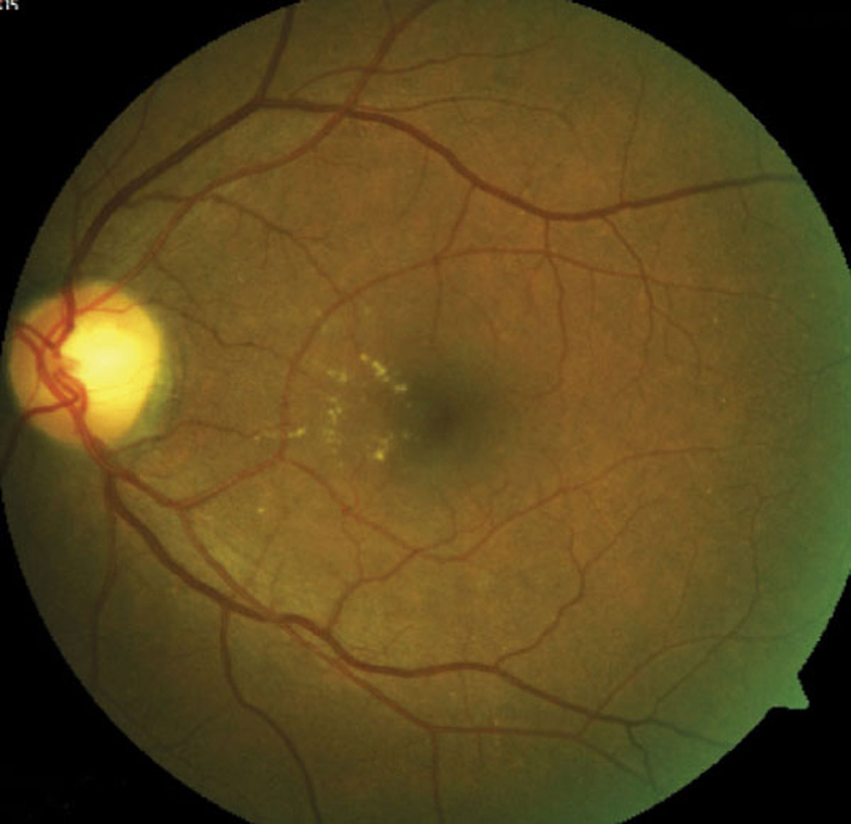 Efforts to ensure a fluid-free macula will help optimize visual outcomes.