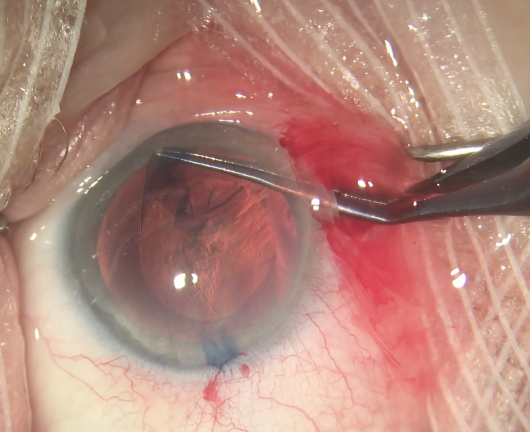 To ensure an uneventful cataract surgery, as seen here, be sure to carefully assess risk factors for PCR beforehand. A new study links intravitreal injection to risk elevation.