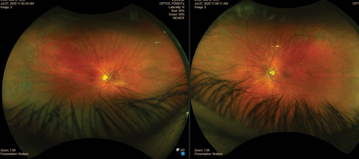 Data from this study suggested patients who undergo macula-off RRD fare worse compared with those who undergo macula-on RRD.