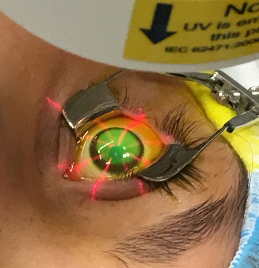 This method of accelerated crosslinking had good outcomes in patients with thinner corneas.