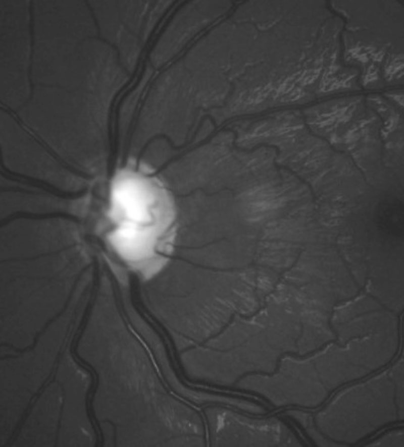 Be especially vigilant for signs of glaucoma in pediatric patients with congenital cataract.