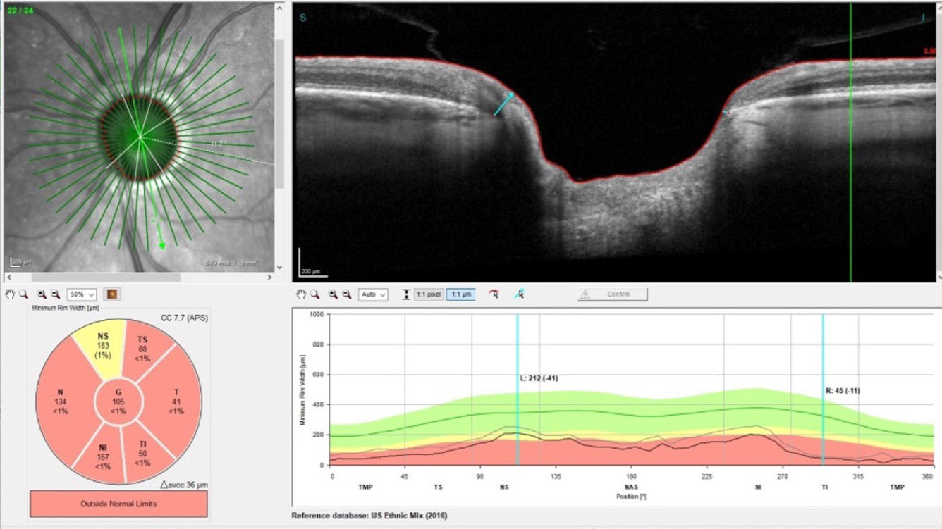 Progression can be seen in the damage to the neuroretinal rim OS.