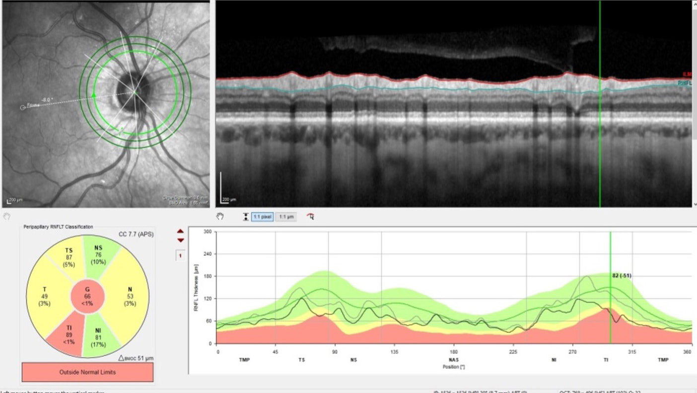 Changes in perioptic RNFL indicate conversion to frank glaucoma.