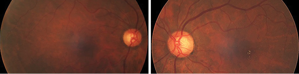 Figs. 1 and 2. Fundus photos of the right and left retina eyes. What do you see in her macula?