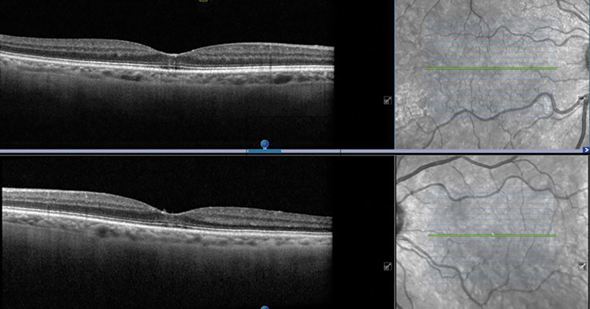 Fig. 3. Heidelberg OCT of the right and left eyes. Is this normal?