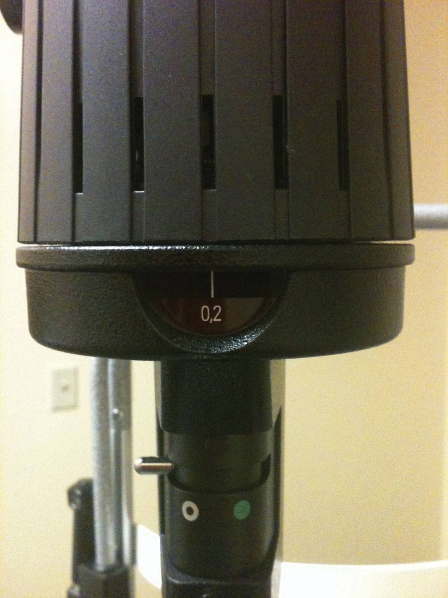 The 0.2mm spot size on your slit lamp can be used to help estimate TMH.