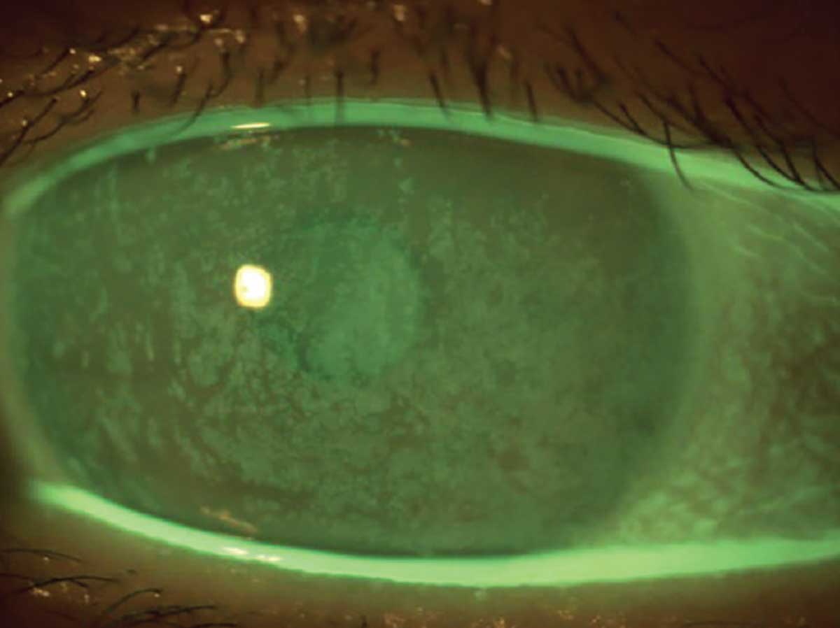 Patients with chronic LASIK-induced dry eye may require advanced therapies.