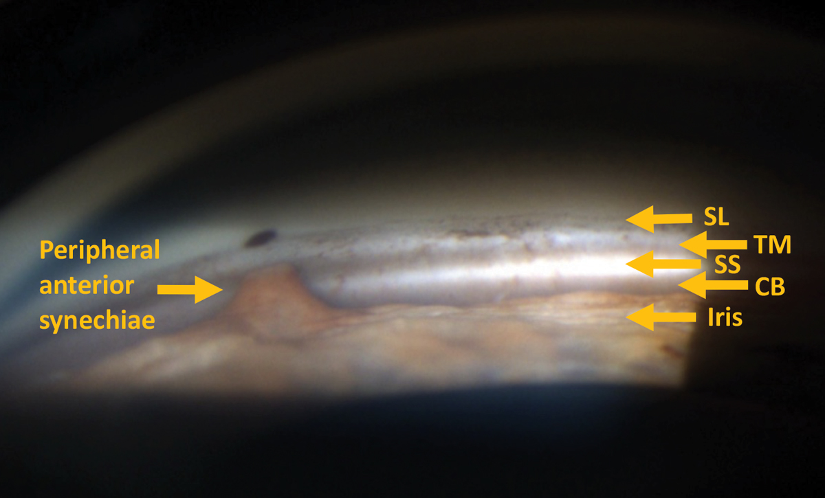 Gonioscopy reveals peripheral anterior synechia.
