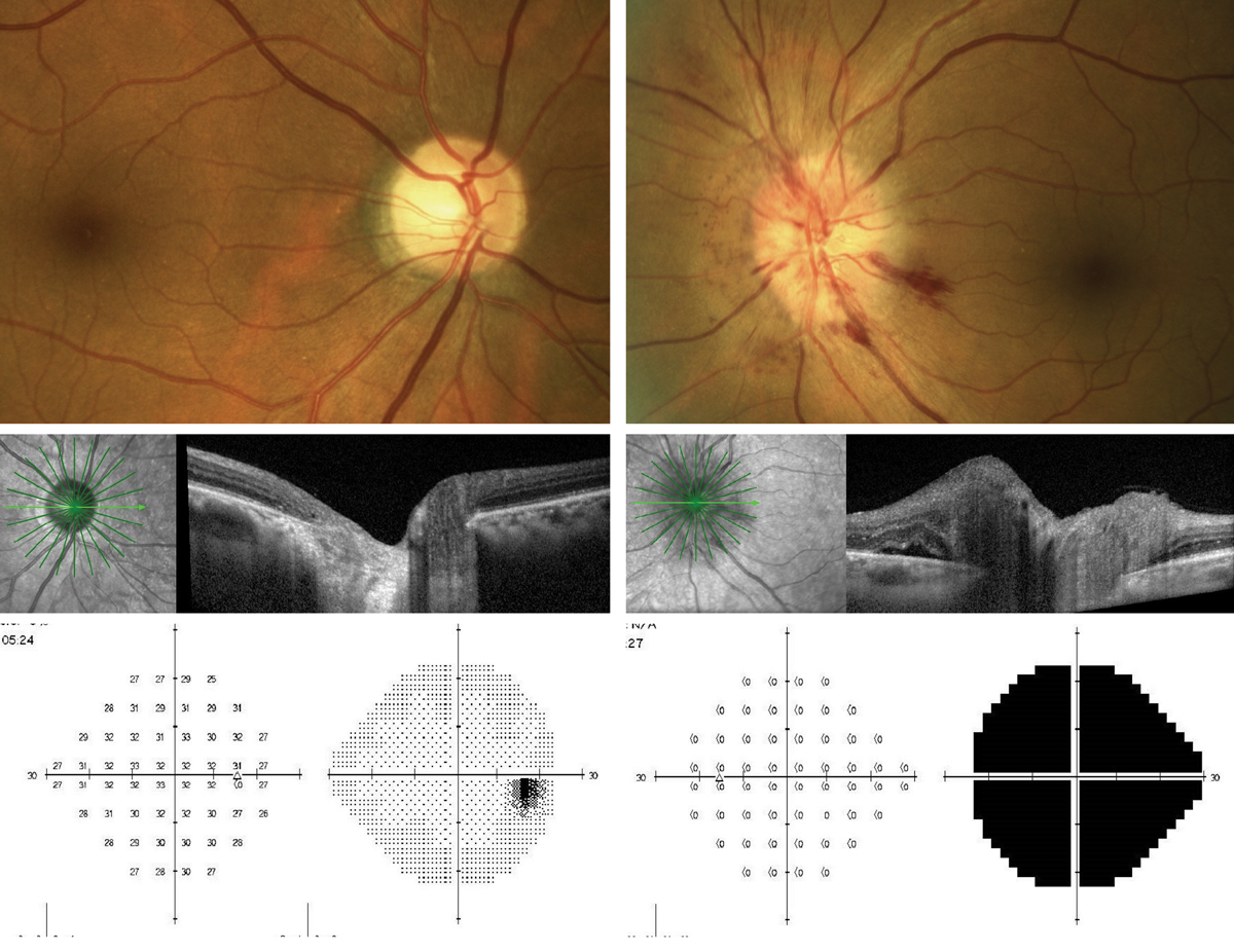 Presentation of AAION OS. Note the peripapillary hemorrhages and swelling of the optic nerve seen on OCT as compared with the normal right eye. The 24-2 threshold visual field OS shows significant depression of the left eye, while the right eye remains normal.