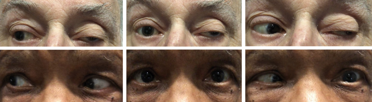 Cranial nerve III palsy with exotropia, hypotropia and ptosis OS (top). There is restriction of left adduction, supraduction and infraduction. Note, both pupils are pharmacologically dilated. Isolated cranial nerve VI palsy OS (bottom). Note the subtle left esotropia in primary gaze with complete loss of abduction and normal adduction.