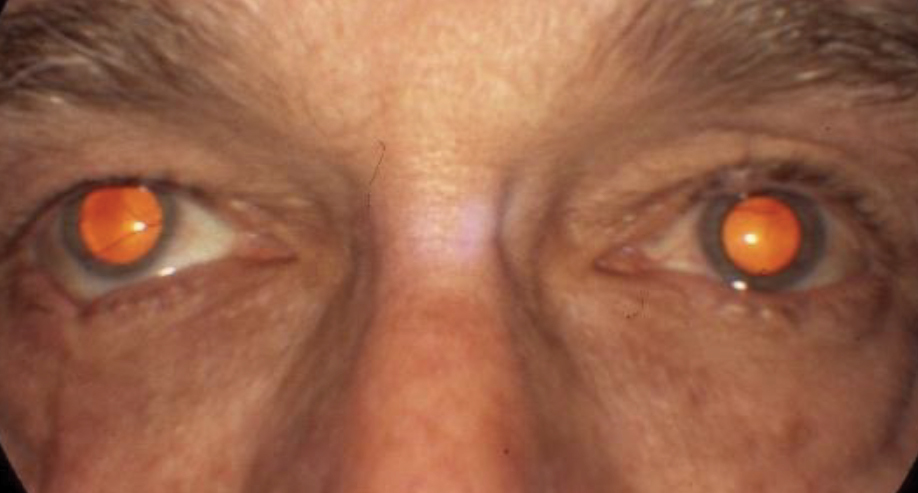 This patient developed diplopia after a car accident. He has a cranial nerve IV palsy with an up and out deviation OD shown in primary gaze, which is exaggerated by the traumatic scar on the lower lid of the same eye.