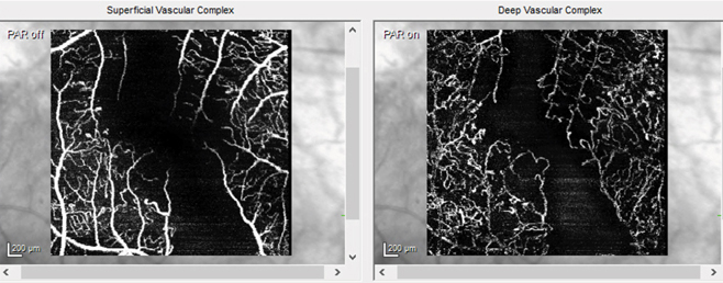 An early warning sign of cognitive issues may be seen in loss of retinal microvascular perfusion on OCT-A (shown here in an unrelated diabetic retinopathy patient).