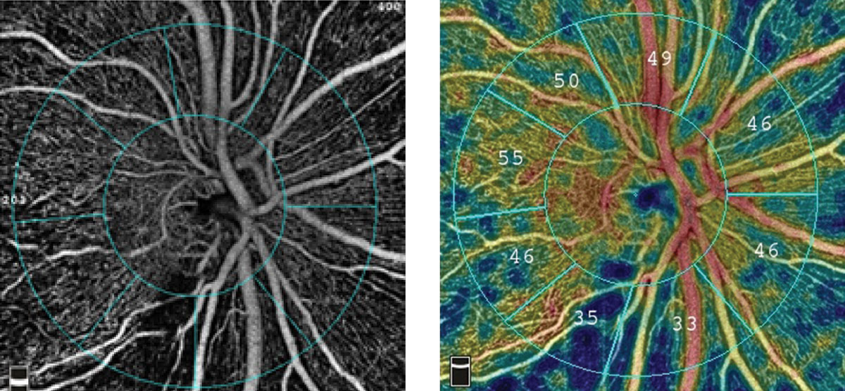Observing for rapid vessel density loss in glaucoma patients may help monitor progression and predict visual field loss.