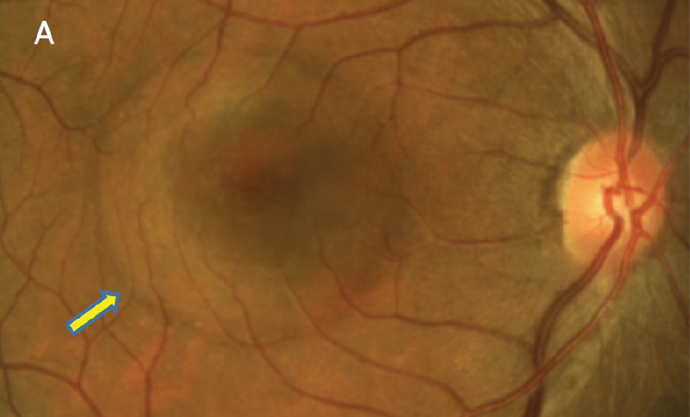 Scleral thickness could have implications in the pathogenesis of central serous chorioretinopathy.