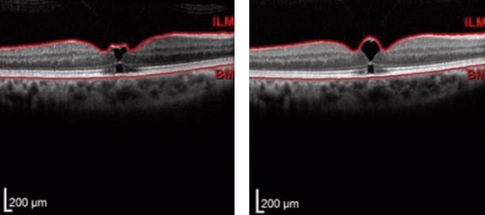 Vitreomacular traction (shown here using conventional OCT methods) is one condition that may be better visualized and understood if a new OCT technique becomes refined and put into practice.