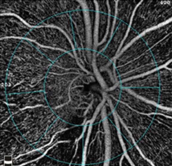 3D retinal imaging was actually shown to surpass the performance of RNFL thickness as a tool for glaucoma detection. 