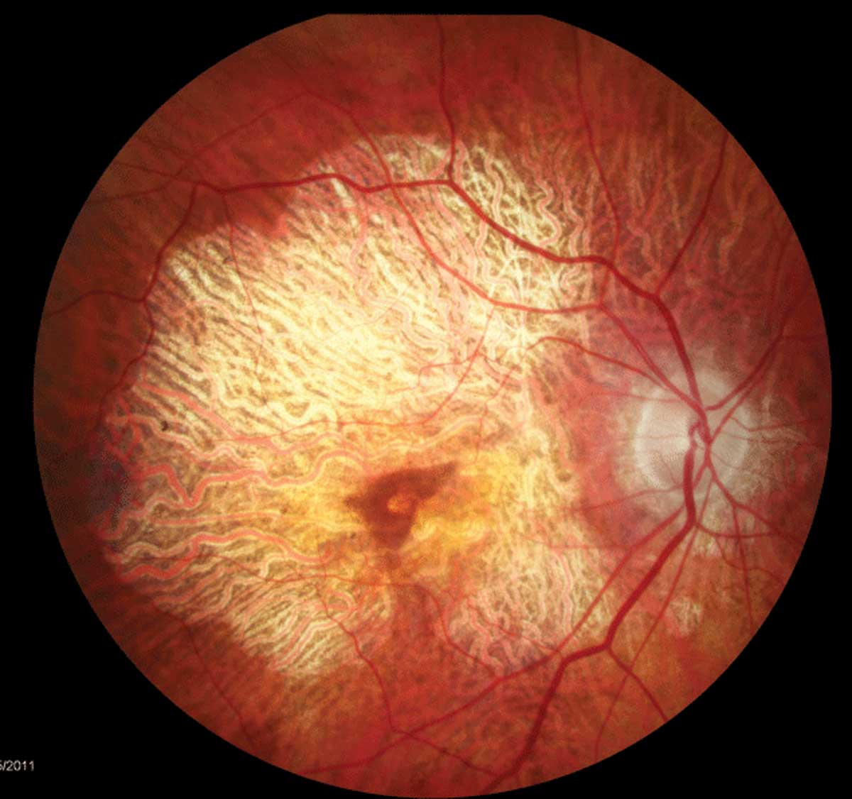 The MDS test may be useful for evaluating contrast sensitivity in patients with AMD.