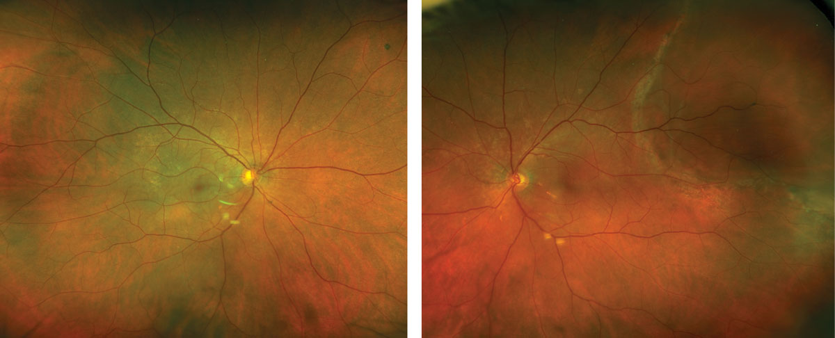 Figs. 1 and 2. Ultra-widefield fundus photography of the right eye (left) and left eye (right).