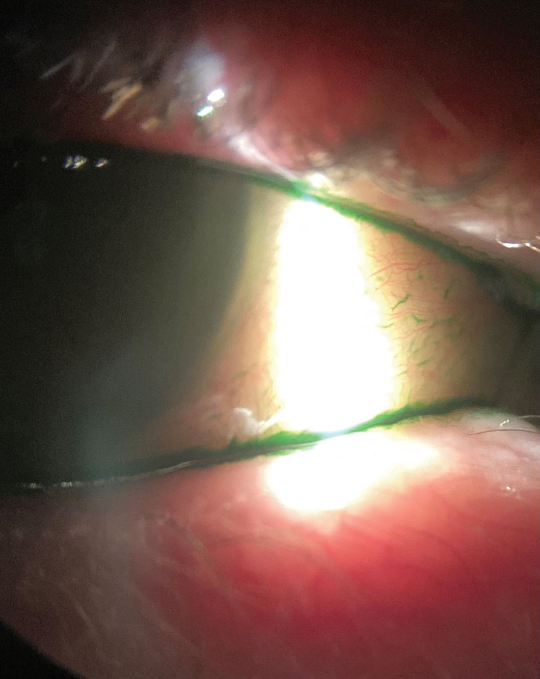 Lissamine green vital dye, shown here in a dry eye patient with inflammation, helps visualize devitalized cells on the conjunctiva.
