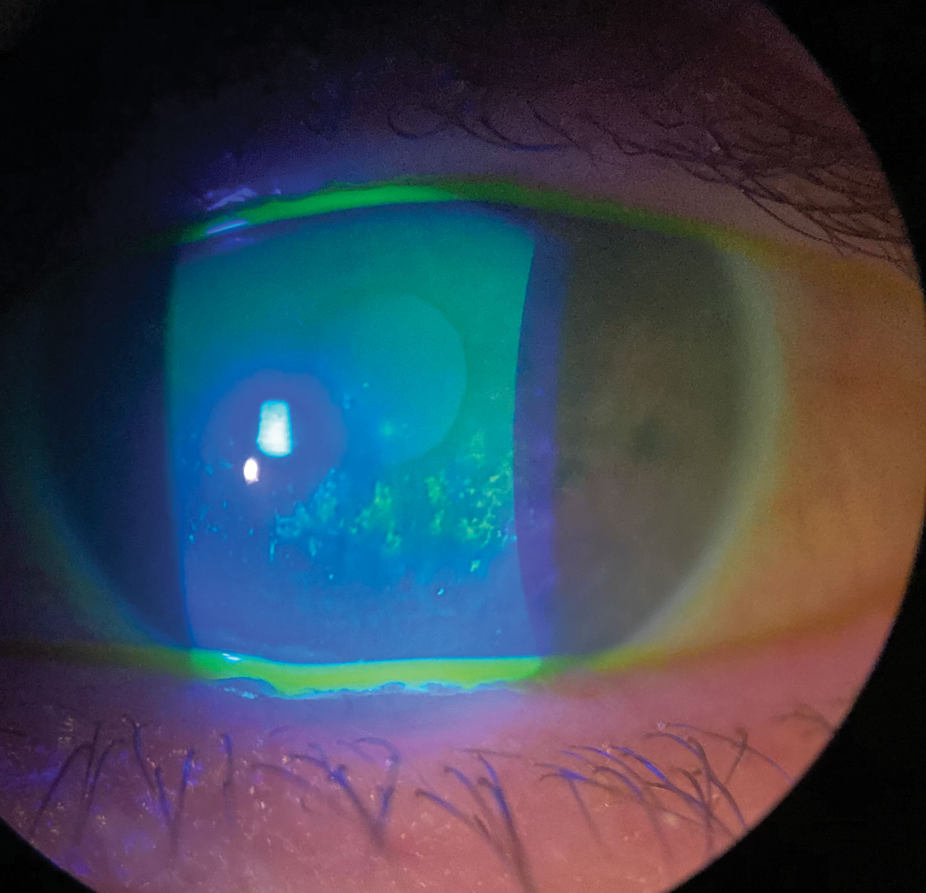 A 2+ band of corneal punctate epithelial erosion in a patient with severe keratoconjunctivitis sicca.