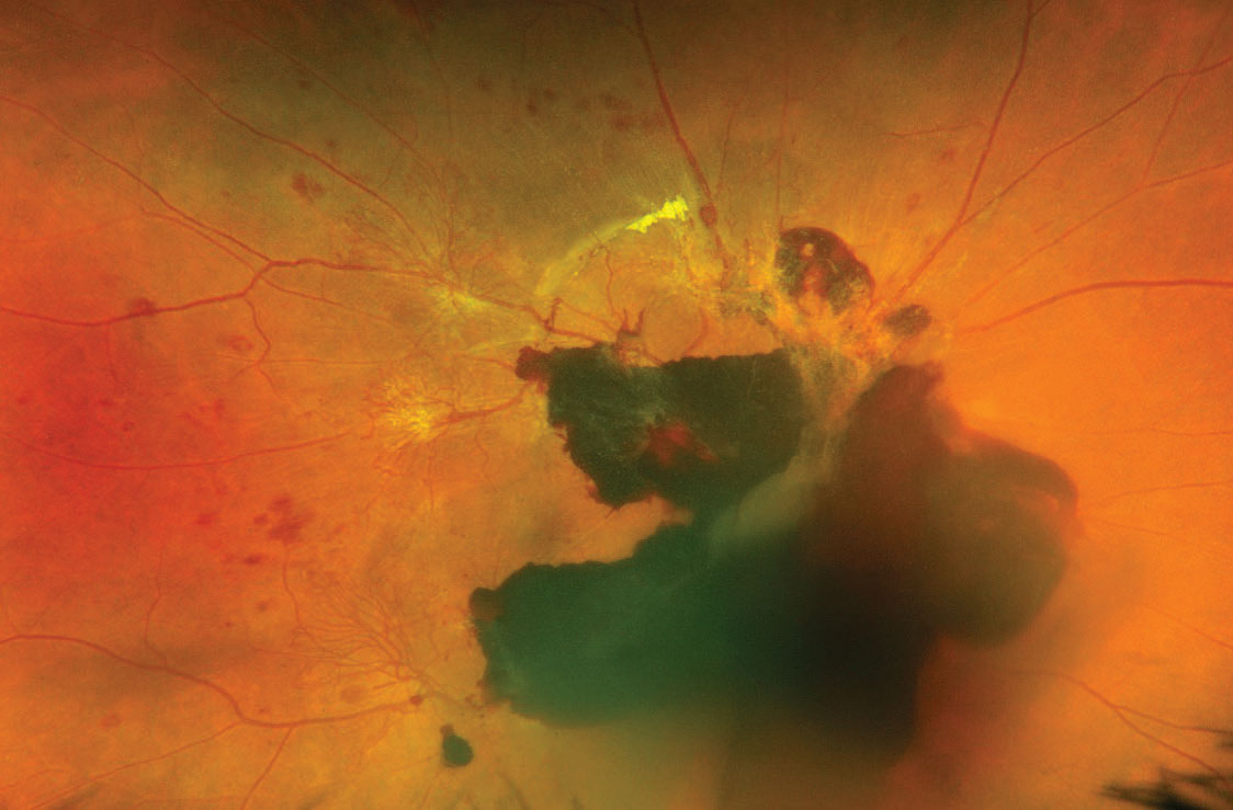 Fig. 1. Fundus photo of the first patient shows vitreous and subhyaloid hemorrhages with active neovascular fronds extending from the arcades.