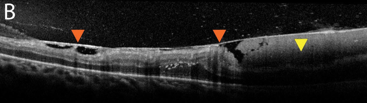 Fig. 2b. An additional OCT image shows a thickened hyaloid with an adherent or “sticky” retina (orange arrows). The subhyaloid hemorrhage can be seen here in higher quality (yellow arrow).