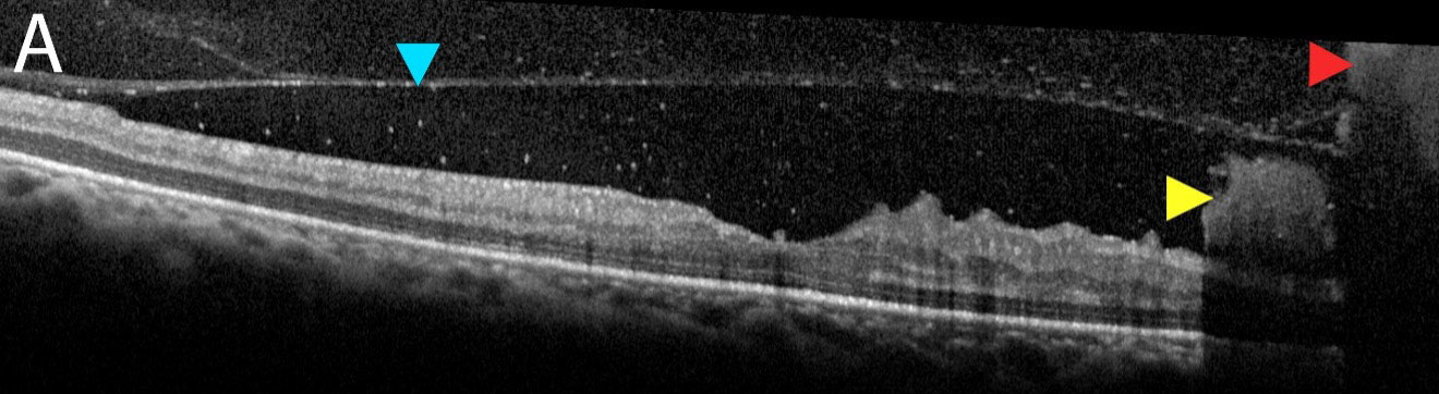 Fig. 2a. OCT raster scan of the foveal pit demonstrates posterior hyaloid face (blue arrow) with both subhyaloid and preretinal hemorrhages (yellow arrow) and a VH (red arrow).