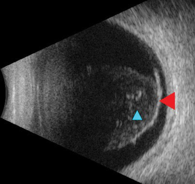 Fig. 3. Ultrasound reveals a detachment of the posterior hyaloid face from the retina (red arrow). Notable vitreous debris (blue arrow) was appreciable on clinical exam as a hemorrhage.