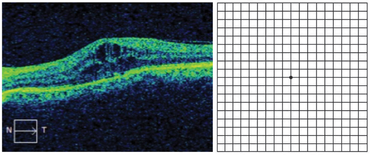Cystoid macular edema (left), which would manifest as central metamorphopsia on Amsler grid (right).