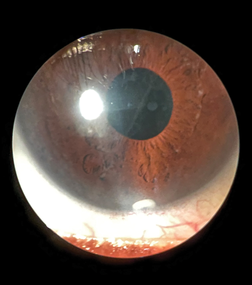 Anterior segment slit lamp photo of Durysta implant still visible at six-month follow-up.