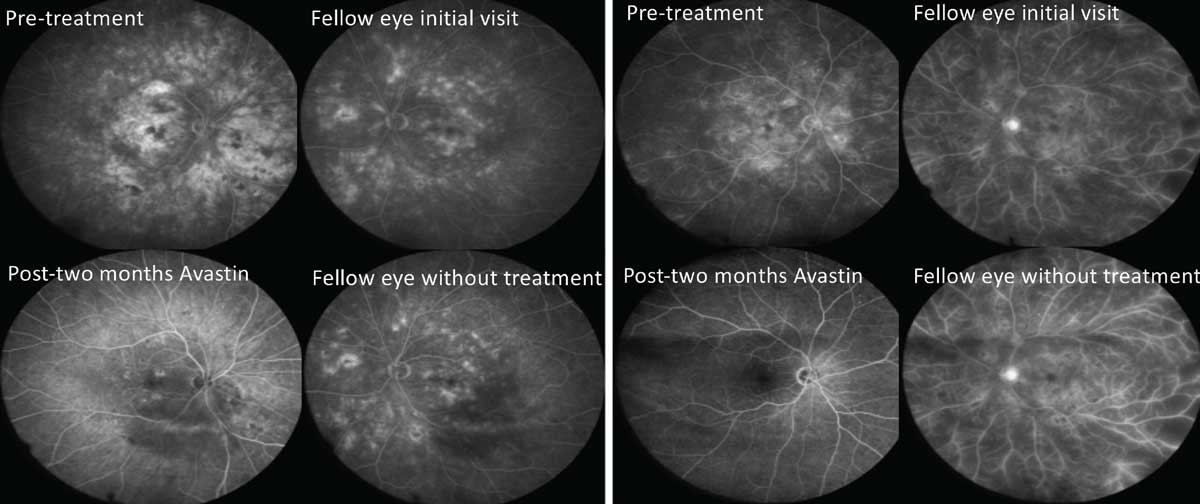 Fig. 2. Periodic treatment with anti-VEGF has been shown to reverse severity of retinopathy, a benefit beyond simply treating DME and proliferative disease. This figure shows fluorescein angiographies of two separate patients with severe NPDR. The OD of each patient was treated with two monthly injections, while the OS was monitored. Notice the profound improvements in the treated eyes vs. lack of improvement in the untreated fellow eyes. 