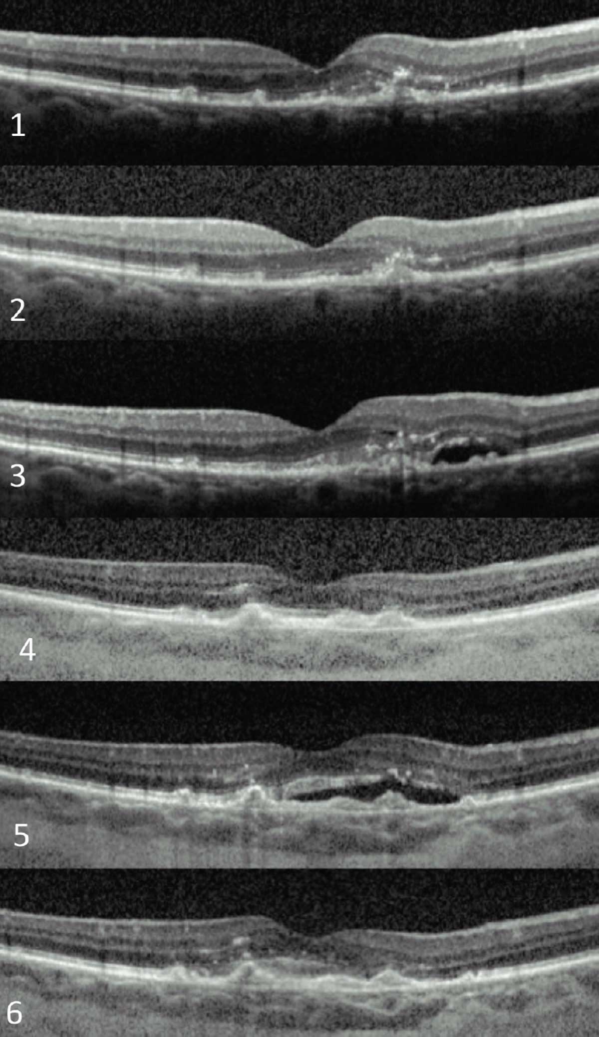 Fig. 3. An exudative AMD patient who has required over 20 anti-VEGF injections in nine years to maintain 20/40 visual acuity. These are a few snapshots in time during the course of her treatment. 