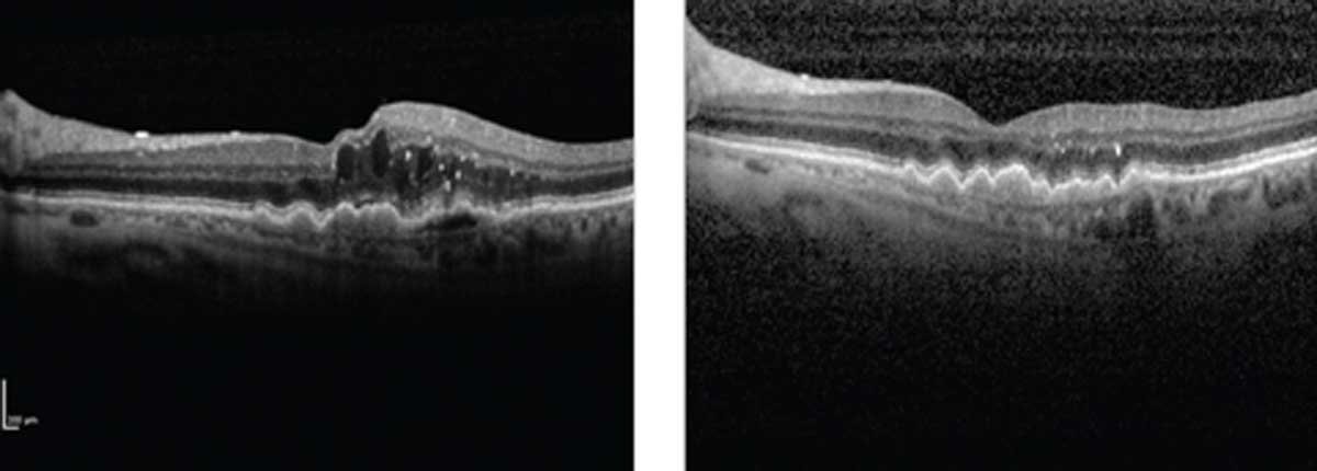 Depending on where the neovascular lesion was located, visual acuity outcomes were detected among the nAMD patient cohort in this study.