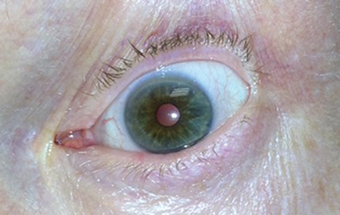 Pupil constriction following (therapeutic) pilocarpine use. ODs are familiar with previous incarnations of the drug after decades of medical use prior to its FDA approval for presbyopia.