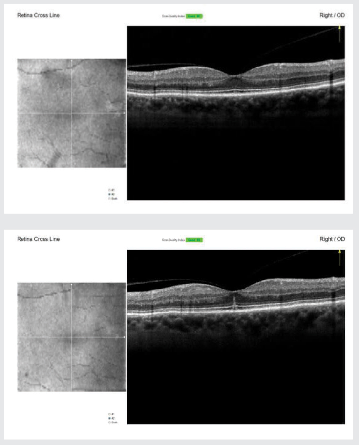 OCT scans of Dr. Caul’s right eye taken before (June 2021, top image) and after (February 2022, bottom image) her adverse event.