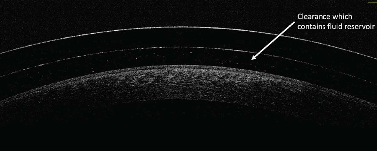 The space between the posterior lens surface and the anterior corneal surface contains the fluid reservoir.