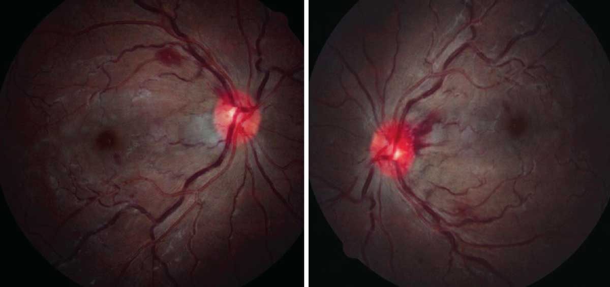 Fundus evaluation revealed these findings. What do these images suggest about his status? What laboratory results might you expect based on this presentation?