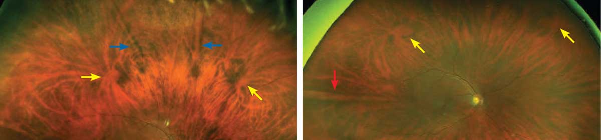 Myopic patients had about 10% increased sensitivity for peripheral lesion detection using ultra-widefield imaging. 