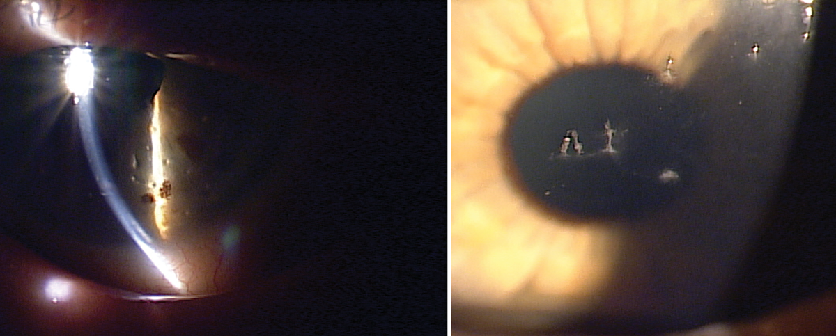Filamentary keratitis with mucin and epithelial cells adhering to the corneal surface.