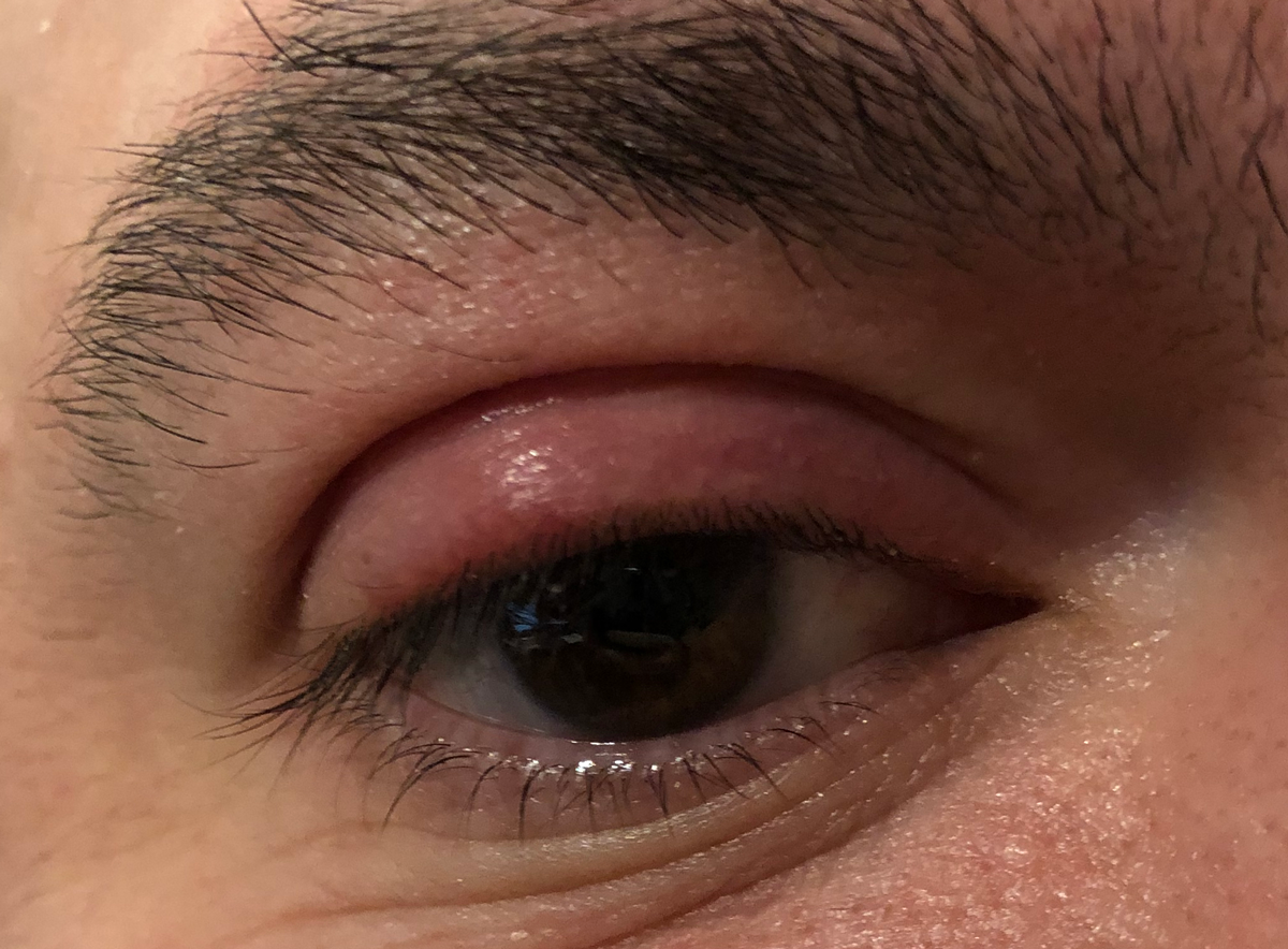 This patient has an internally-pointed hordeolum of the upper eyelid, a finding commonly associated with MRSA infection.