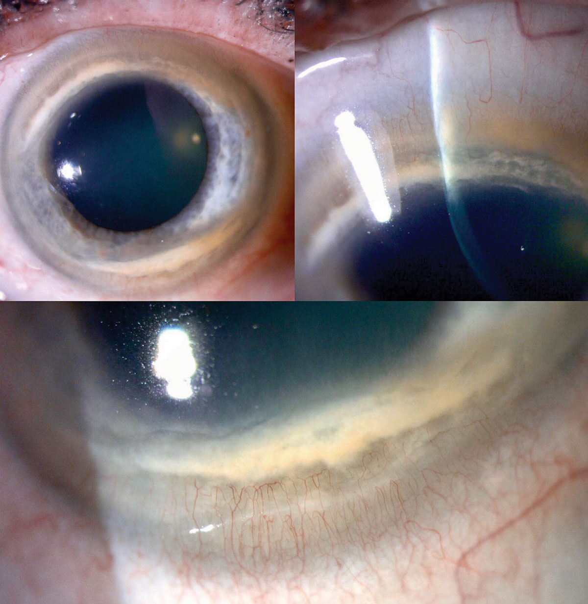 Case 2. Slit lamp exam showed paralimbal corneal thinning with neovascularization and lipid deposits bilaterally.
