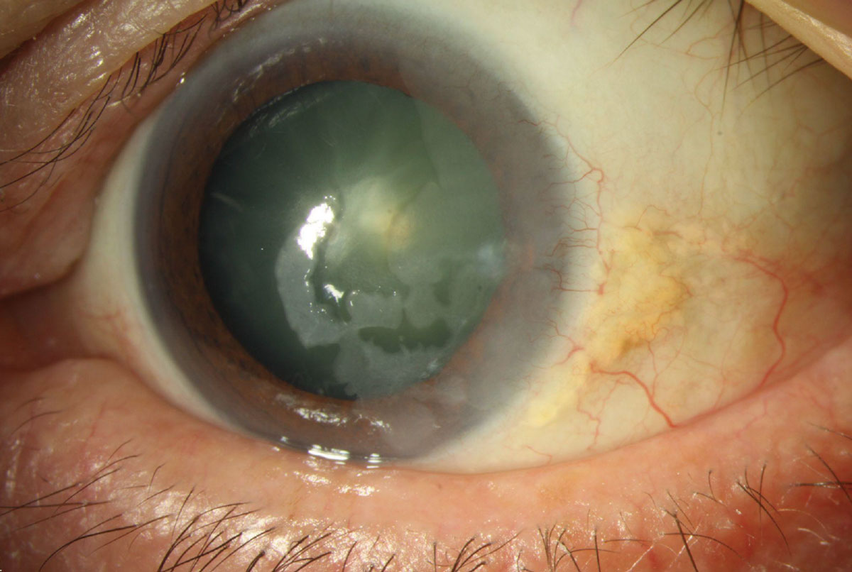 Case 4. This patient had an irregular swath of hazy epithelium without vascularization or ulceration in his left cornea.